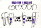 固定义齿的方法