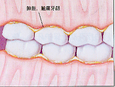 防治牙周炎的重要性