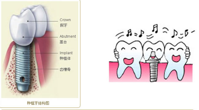种植牙最“时髦”得牙