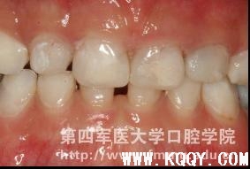 乳牙龋病充填治疗