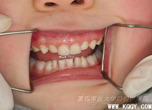 乳牙龋病的治疗病历