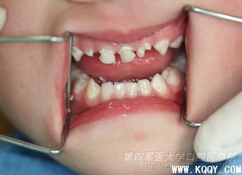 乳牙龋病的治疗