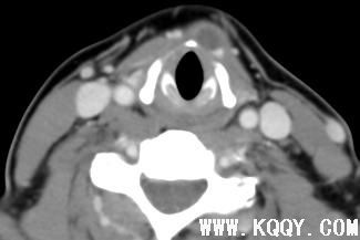 甲状舌管囊肿CT影像图
