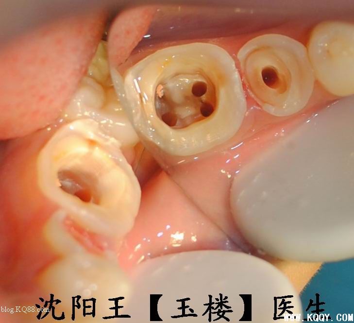 后牙核桩冠一例