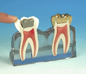 损坏严重的牙为什么要做牙冠