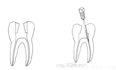 改良开髓位置保护牙体组织