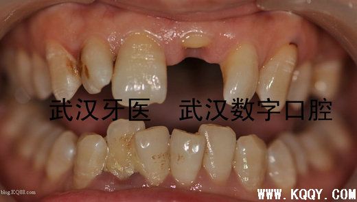 CEREC 3D一小时全瓷修复简介（附临床病例）