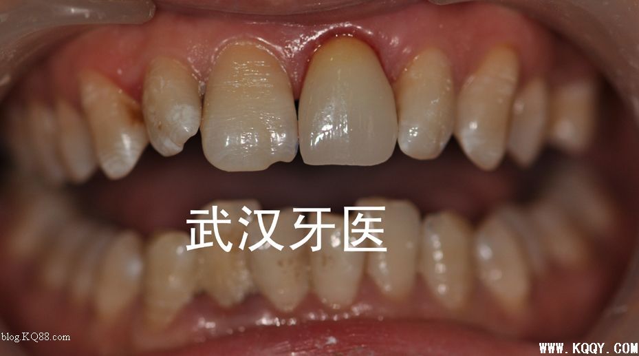 CEREC 3D一小时全瓷修复简介（附临床病例）