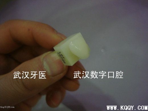 CEREC 3D一小时全瓷修复简介（附临床病例）