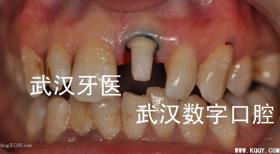 CEREC 3D一小时全瓷修复简介（附临床病例）