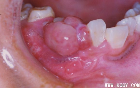 牙龈瘤概述