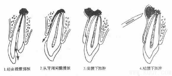 口腔颌面牙体常见疾病——根尖周病综述