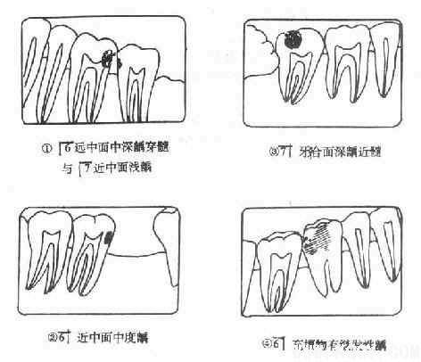 口腔颌面常见疾病——龋病综述