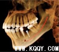 KaVo 3D口腔锥体束CT在口腔种植的应用