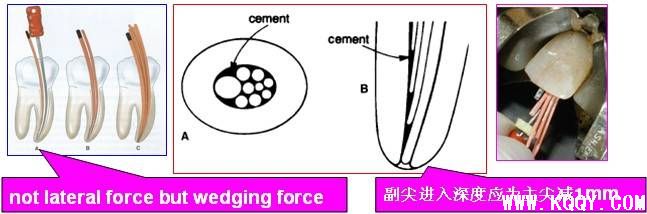 根管治疗测压充填图解