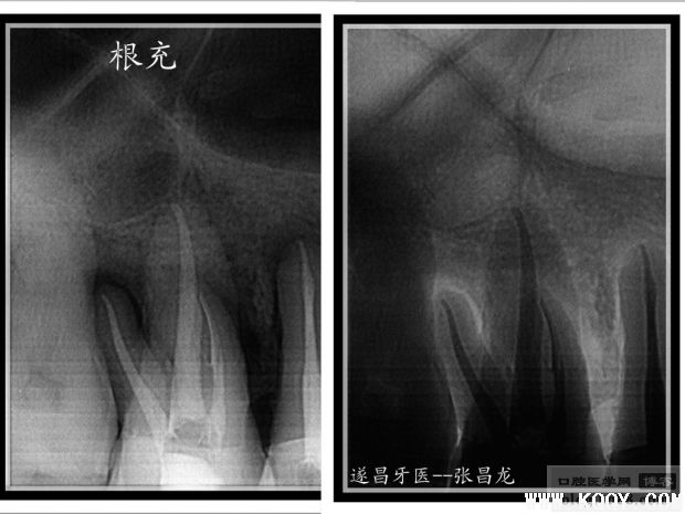 拿什么拯救你——我的断针