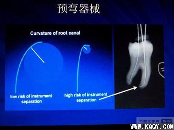 弯曲根管的预备基础