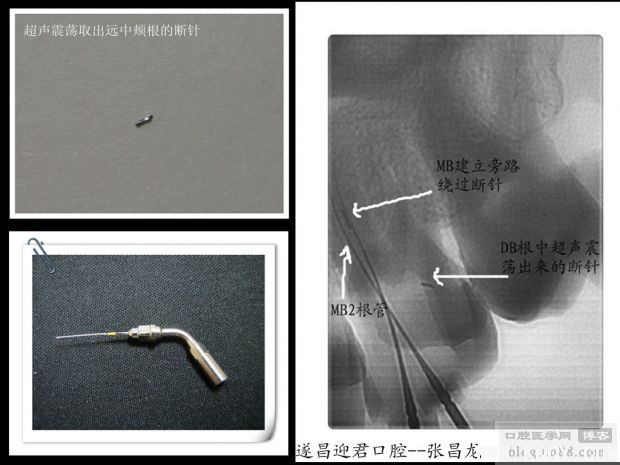 拿什么拯救你——我的断针