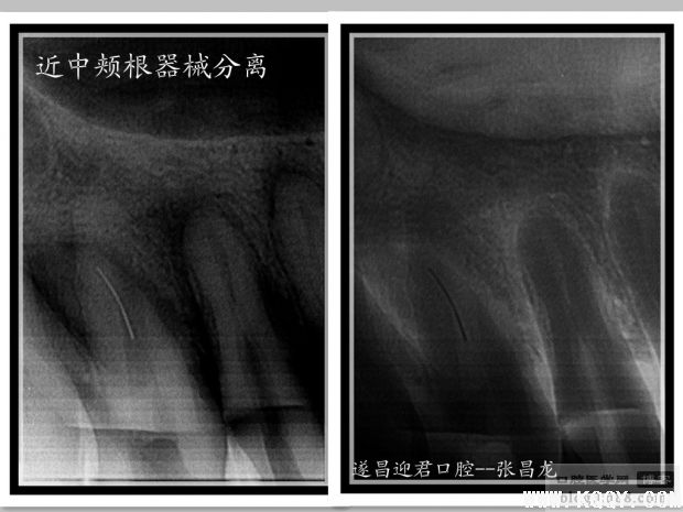 拿什么拯救你——我的断针