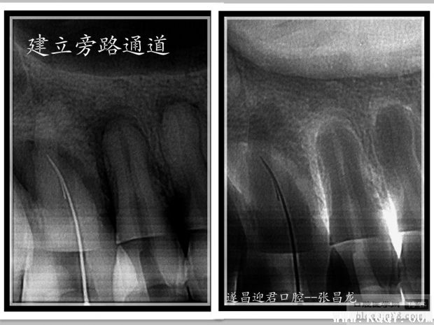 拿什么拯救你——我的断针