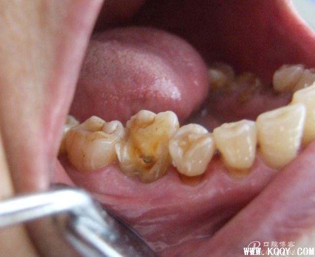 《实用牙髓病诊疗学》第2版分享3-牙体牙髓-口腔前沿网