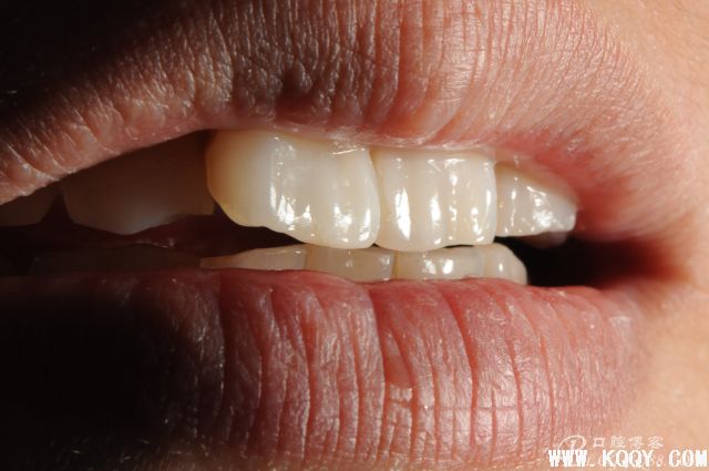 前牙分层树脂病例