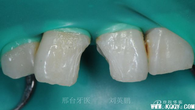 前牙分层树脂病例