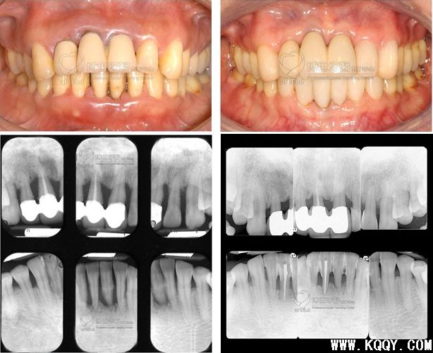 临床案例-牙周篇:再生手术/非手术/保存无救牙