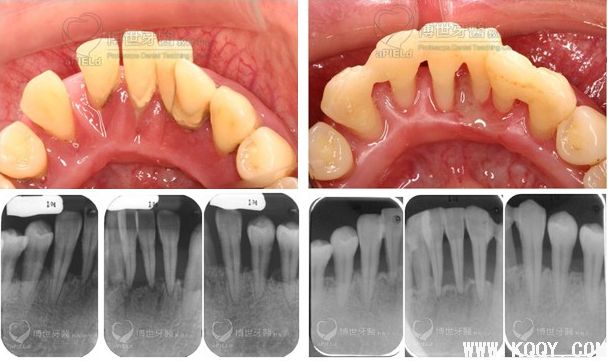 临床案例-牙周篇:再生手术/非手术/保存无救牙