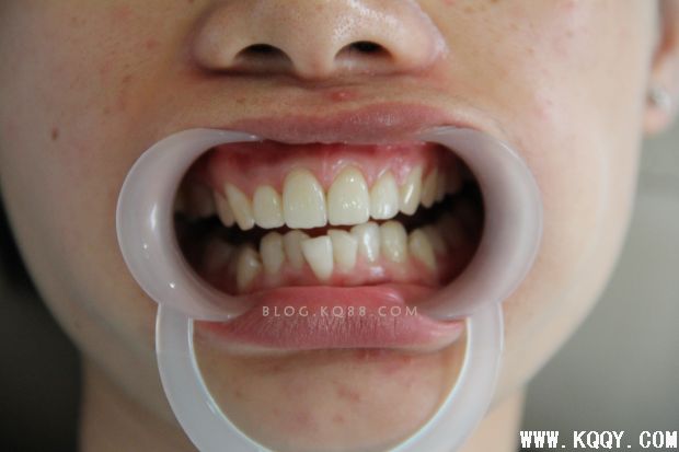 前牙氧化锆美学修复及详细步骤