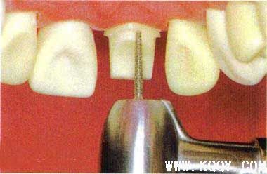 全瓷牙备牙过程图片