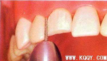 全瓷牙备牙过程图片