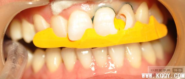 前牙美容性树脂修复-硅胶导板