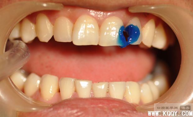 前牙美容性树脂修复-硅胶导板