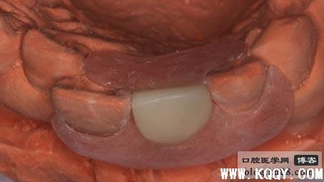 拔牙后过渡性的临时冠做法