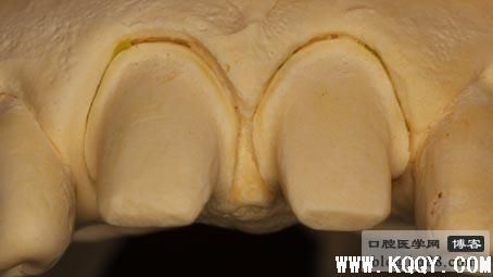 树脂牙面+自凝制作做临时冠