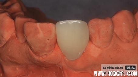 拔牙后过渡性的临时冠做法