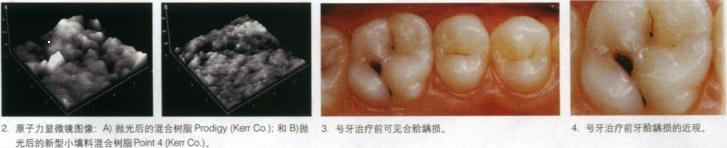 直接复合树脂修复：获得预期后牙效果的临床操作回顾