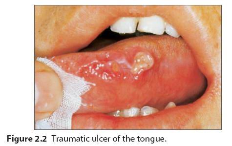 口腔黏膜溃疡图片