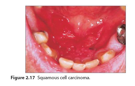 口腔黏膜溃疡图片
