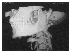 三维CT影像技术在颌面骨骨折诊治中应用的初步报告