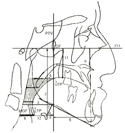 正颌手术前后舌骨位置和咽下气道变化及相关性研究
