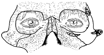 颧骨陈旧性骨折截骨复位术的改良方法