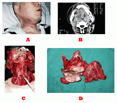 全舌、口底及全喉切除与重建术治疗晚期口腔颌面部恶性肿瘤