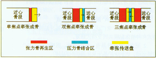牵引成骨术在口腔颌面外科的应用