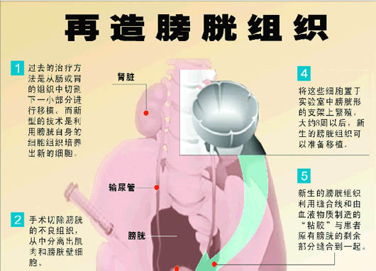 美科学家首次成功再造膀胱组织