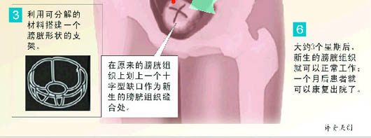 美科学家首次成功再造膀胱组织