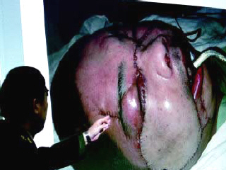 国内首例“换脸”手术在西安成功