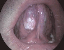 舌癌的外科治疗