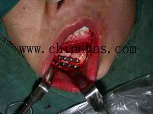 完全经口内入路面部复合性骨折复位内固定术